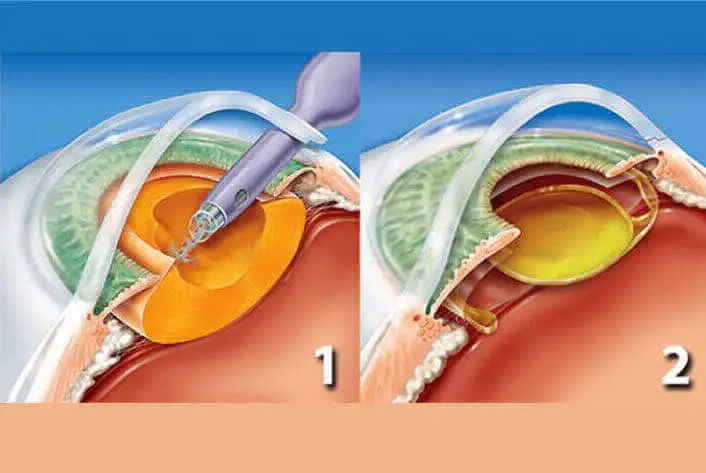 CORRECCIÓN DE PRESBICIA