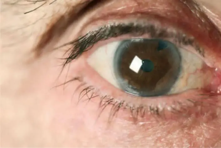 CIRUGÍA DE GLAUCOMA