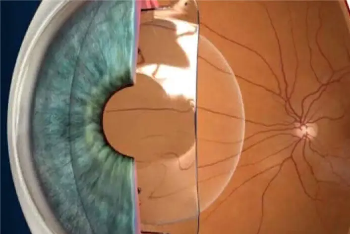 CORRECCIÓN DE MIOPÍA, HIPERMETROPÍA Y ASTIGMATISMO