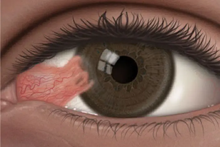 CONJUNTIVOPLASTIA PARA PTERIGIÓN