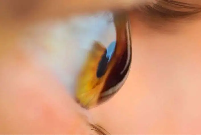 TRATAMIENTO DE QUERATOCONO Y OTRAS ECTASIAS