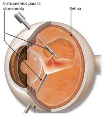 vitrectomía